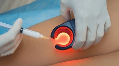 Terapia di venosclerosi per vene varicose