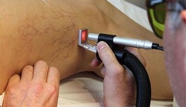 Trattamento laser delle vene varicose
